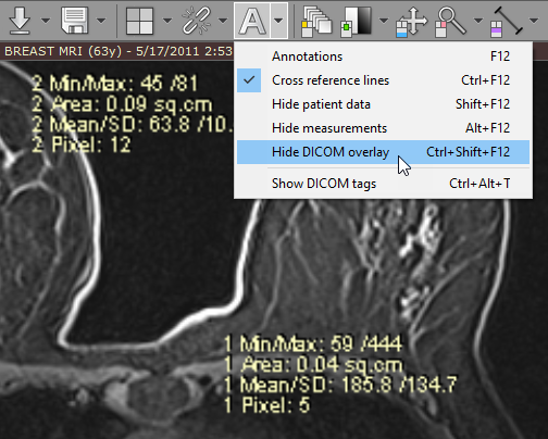 隐藏 DICOM 叠加层菜单