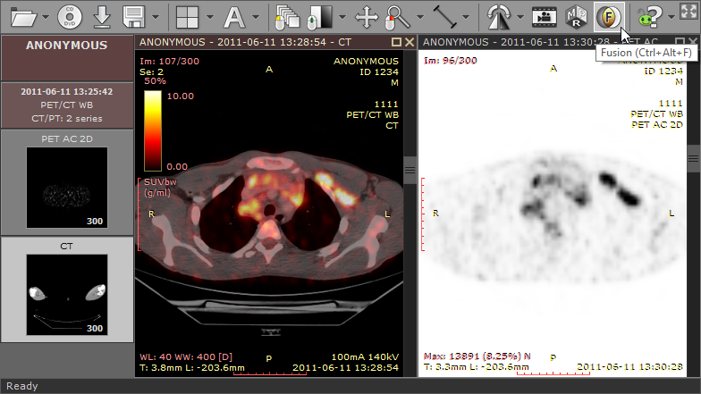 PET-CT 融合图像