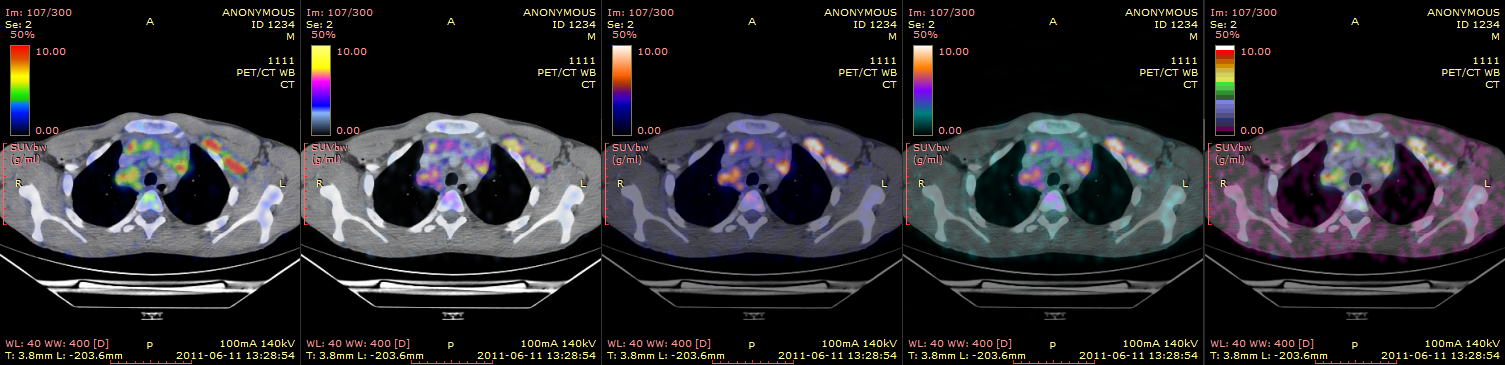 PET-CT 颜色标尺