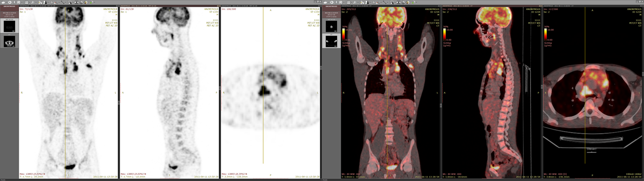 在双显示器上显示的 PET-CT 融合图像